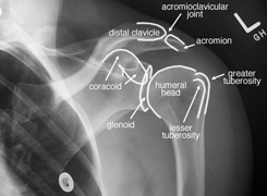 a vállízület röntgen képe