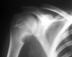 vállizület röntgenképe